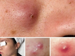 Mụn đinh râu là gì? Cách chăm sóc mụn đinh râu